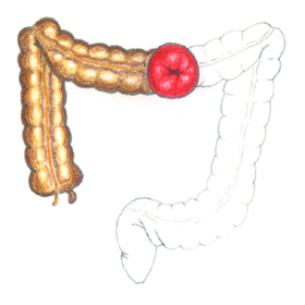 횡행결장루(橫行結腸瘻 : transverse colostomy)이미지