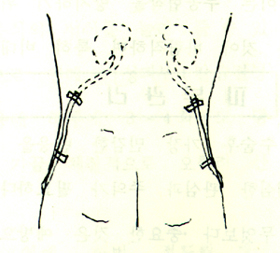 신누설치술(nephrostomy)